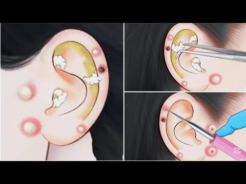 animation 《ASMR》Removing larvae and blackheads from the ear