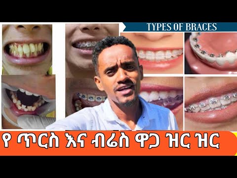 የጥርስ እና የብሬስ ዋጋ   Expert Orthodontist Reveals Teeth And Braces Price List In Ethiopia@AmiroTube