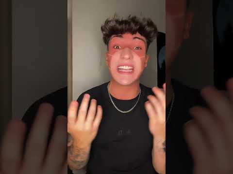 no uso filtros,  tengo una quemadura