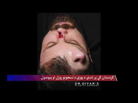 کردستان کې پر تندي د پوزې د نسجونو روزل او پیوندول