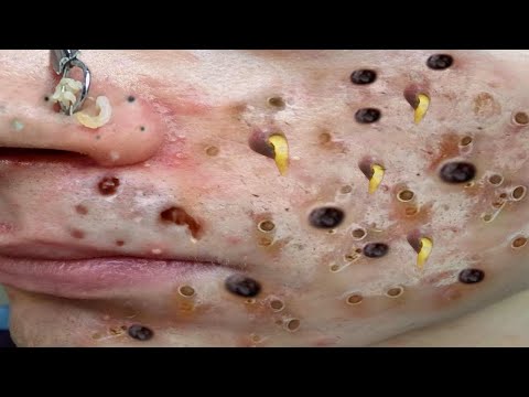 Blackhead Removal With Sac Dep Spa @100074553
