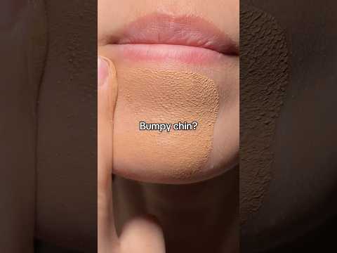 Skincare ingredients for your skin problems #acne #breakouts #bumpyskin #skintexture