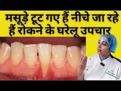 मसूड़ें नीचे जाने को रोकने के घरेलू उपाय | Home remedies to prevent receding gums |