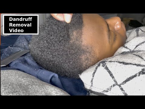 Dandruff Scratching | Dandruff Removal Video