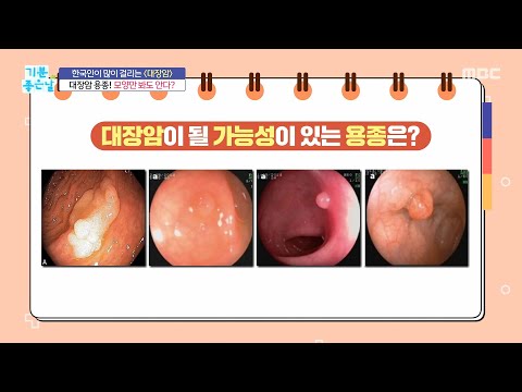 [기분 <strong>좋은</strong> <strong>날</strong>] 용종 모양으로 대장암을 알 수 있다?, MBC 261012 방송