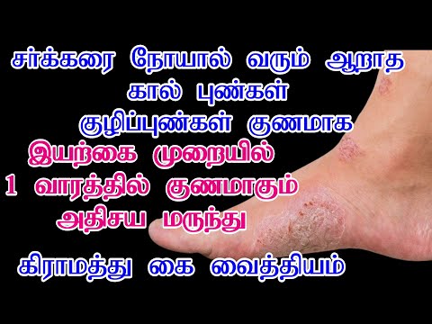 சர்க்கரை நோயால் வரும் கால் புண் குணமாக/Sugar Punnu Marunthu In Tamil/How To Cure Diabetic Foot Wound