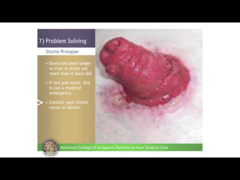 Pediatric Urostomy: Problem Solving