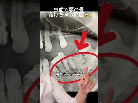 顎の骨が溶ける💀虫歯放置の恐怖🦷🫨