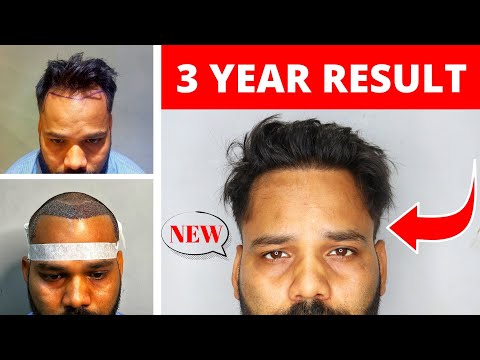 My 3 Year Hair Transplant Result Is Insane 🔥 Best Hairline Ever Created By Hair Transplant