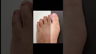 MINIMALLY INVASIVE BUNION & TOE STRAIGHTENING TRANSFORMATION 🦶🏼#shorts #juanetes