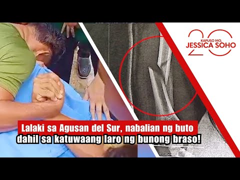 Lalaki, nabalian ng buto dahil sa pa-tournament ng bunong braso! | Kapuso Mo, Jessica Soho