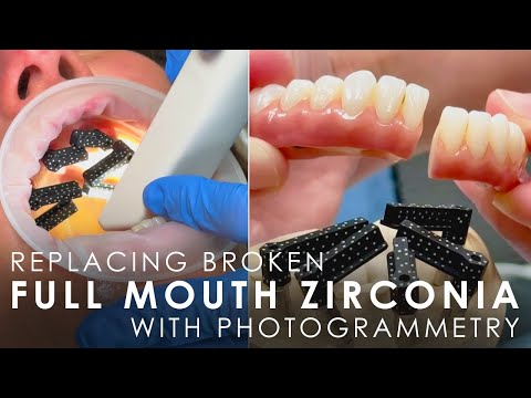 Replacing Broken Full Mouth Zirconia with Photogrammetry Techniques