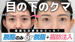 【目の下のクマ取り・脂肪注入】脱脂のみと脱脂＋脂肪注入どっちが良い？手術から半年間のダウンタイムに密着！