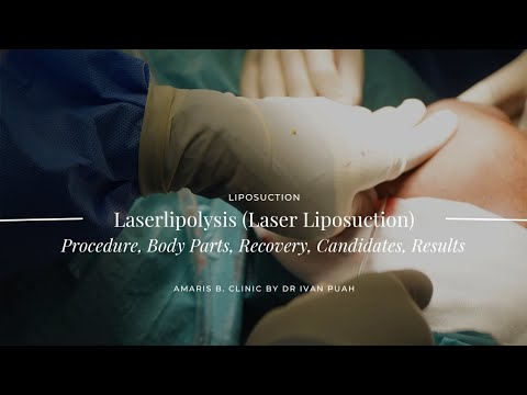 Laserlipolysis (Laser Liposuction): Procedure, Body Parts, Recovery, Candidates, Results | Amaris B.