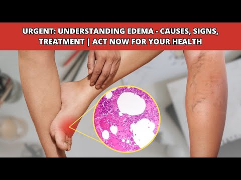 Understanding Edema : Causes, Symptoms, Diagnosis, and Treatment Strategies