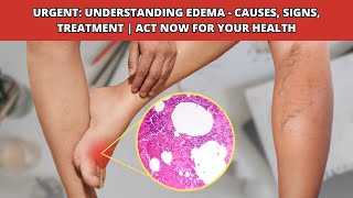 Understanding Edema : Causes, Symptoms, Diagnosis, and Treatment Strategies