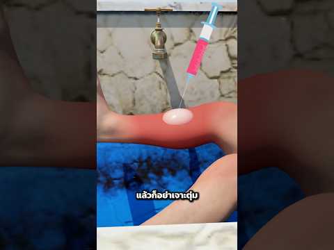โดนน้ำร้อนลวก ทำยังไงดี?!! #น้ำร้อนลวก #ปฐมพยาบาล #สาระความรู้ #แอนิเมชั่น #ร้อนมาก