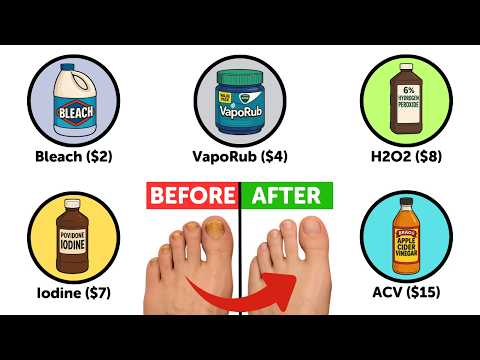 Every Toenail Fungus Home Remedy Explained in 13 Minutes
