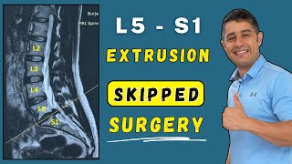 Lumbar disc extrusion L5 S1 recovery without surgery.