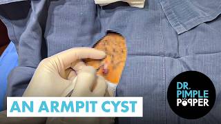 An Armpit Cyst