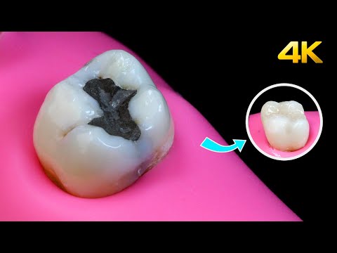 AMAZING Amalgam Filling Replacement!
