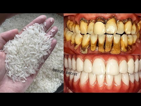 The recipe that dentists are hiding from us🔥!It whitens teeth and eliminates tartar in 1 minutes