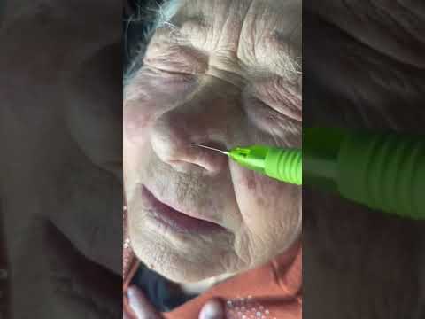 @VOVOSTIKTOKERS HARMONIZAÇÃO FACIAL?