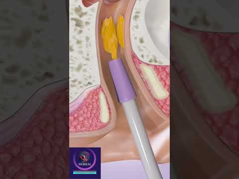 Ear Wax Removal #shorts #education