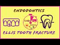 Ellis and Devi Tooth Fracture Classification
