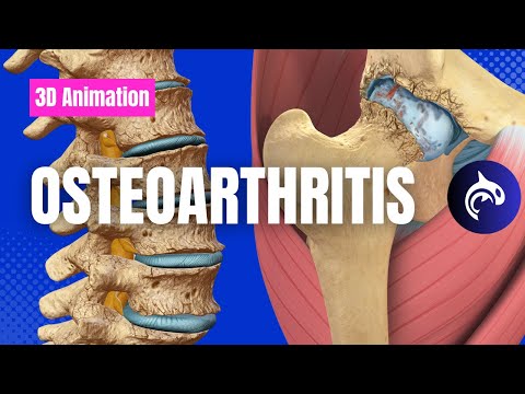 Understand Osteoarthritis - OA of the Knee, Spine, Hip, Hand, Elbow and more