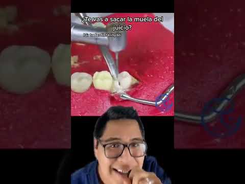 MIRA COMO HABÍA HUESO ENCIMA DE LA MUELA DEL JUICIO