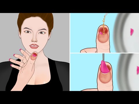 ASMR Remove Broken fingernail from nail matrix | Severely injured animation