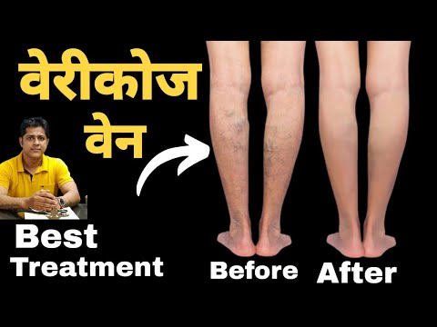 वेरीकोज वेन का ईलाज। Vericose Vein Treatment in Hindi. Exercise for Vericose Vein. #vericoseveins