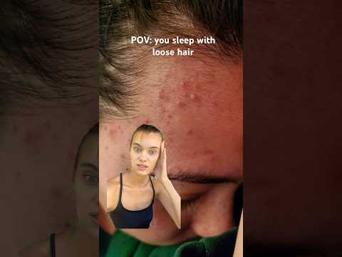 Got acne? Sure it’s not your hair causing it??? #acne #acneproneskin #skincareforacne #acnetips