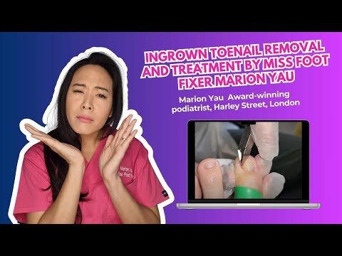 Ingrown Toenail Removal and Treatment by Miss Foot Fixer Marion Yau