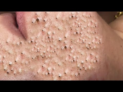 Big Cystic Acne Blackheads Extraction Blackheads & Milia, Whiteheads Removal Pimple Popping # 8402