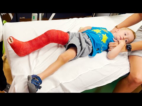 MY 3 YEAR OLDS BROKEN LEG ADVENTURE