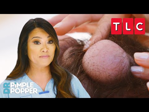 Holy Cyst! Biggest Cyst Removals | Dr. Pimple Popper | TLC