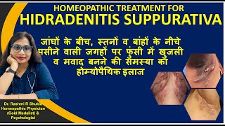 Best Treatment for Hidradenitis Suppurativa