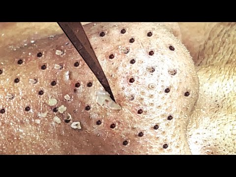 Blackhead Removal With Sac Dep Spa @100074137