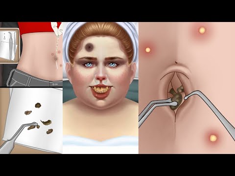 ASMR Extreme Tonsil Stone Treatment | Is Your Belly Button Clean? ASMR Remove Navel Stone Animation