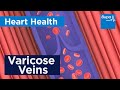 Understanding Varicose Veins