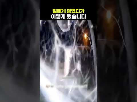 벌에게 덤볐다가 이렇게 됐습니다