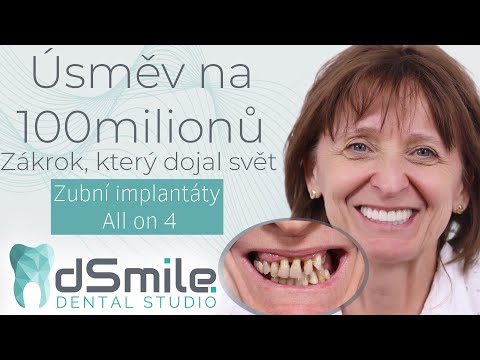 Nejslavnější úsměv v Česku – implantace All-on-4 v Praze
