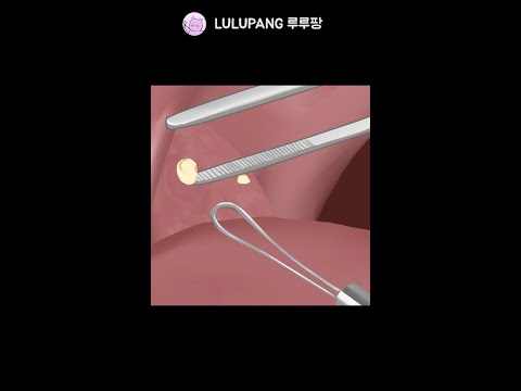 입에서 똥냄새나는 이유, 편도결석 / Tonsil stones #shorts