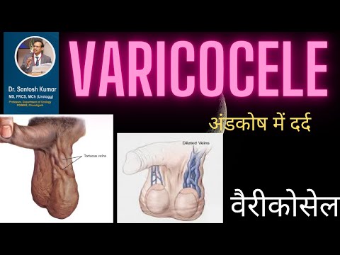 वैरीकोसेल, infertility, Varicocele, .(Prof)Santosh Kumar PGI