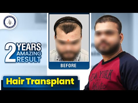 Grade 3 Baldness Hair Transplant in Hyderabad | Hair Transplant Results & Cost in Hyderabad