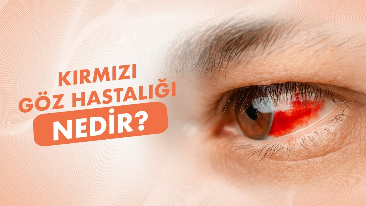 Kırmızı Göz Hastalığı Nedir? | Doç. Dr. Faruk Kaya