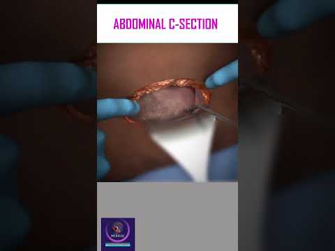 Abdominal C-Section Delivery