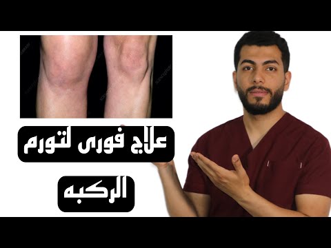 تورم الركبة: الأسباب الخفية والعلاج الفعال لتخفيف الألم فوراً!"